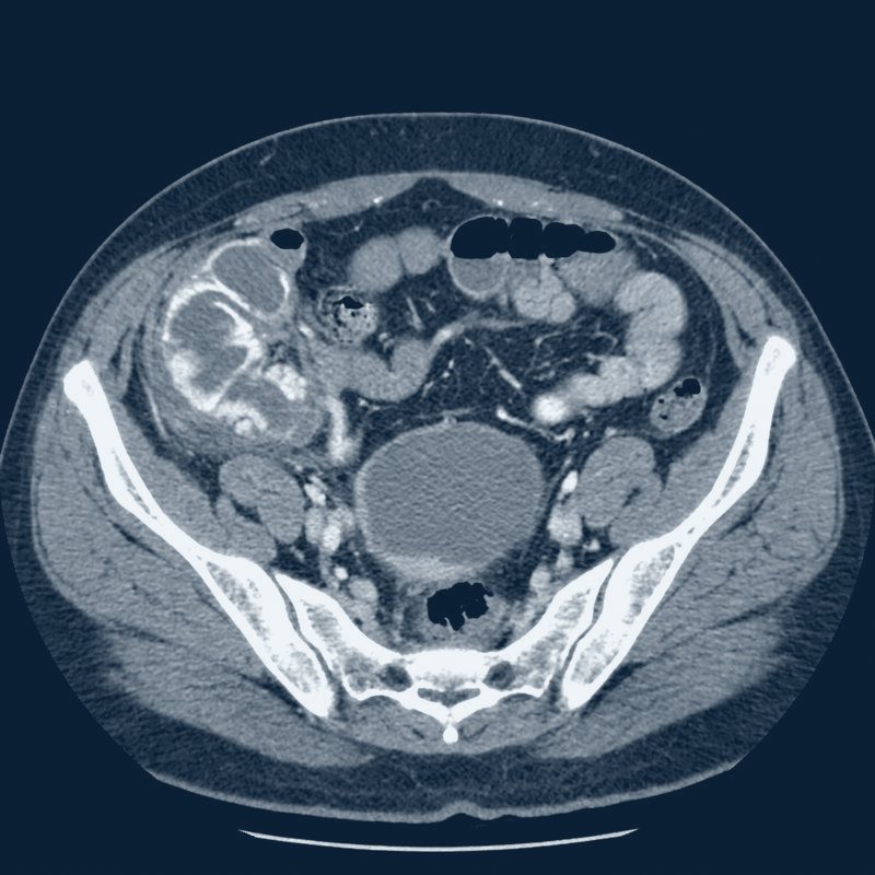 Illustrative contrast CT of the abdomen and pelvis showing acute appendicitis