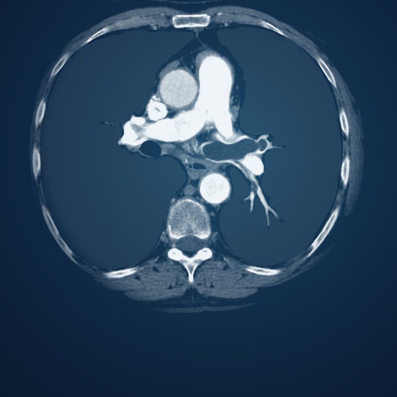 Illustrative CT pulmonary angiogram showing a filling defect in the left pulmonary artery