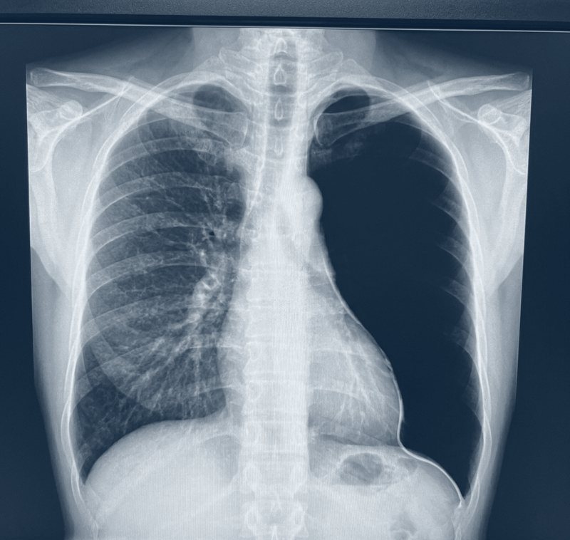 Illustrative upright chest X-ray showing a large left pneumothorax