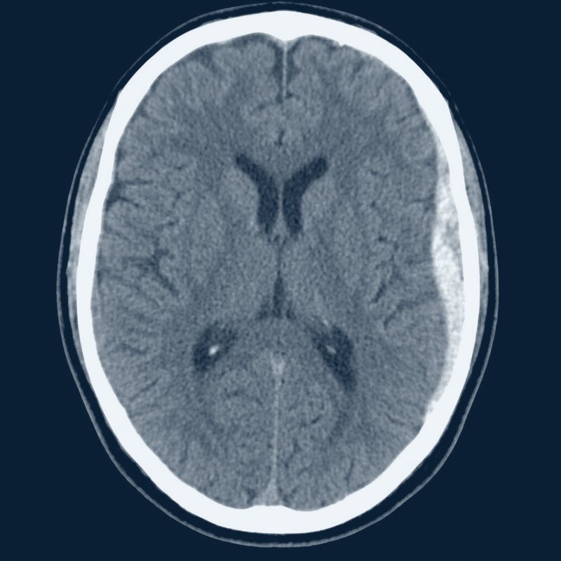 Illustrative non-contrast head CT showing an acute left subdural hematoma
