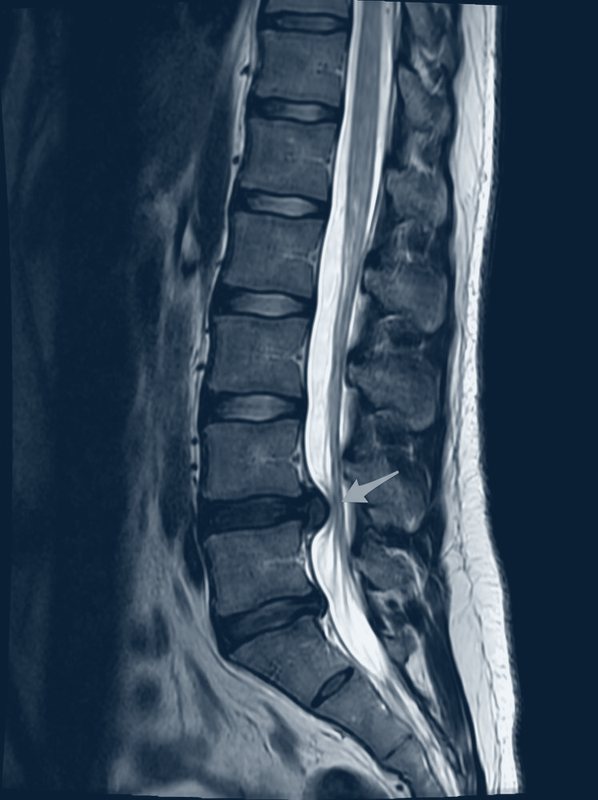 Illustrative sagittal T2 MRI of the lumbar spine showing an L4–L5 disc extrusion