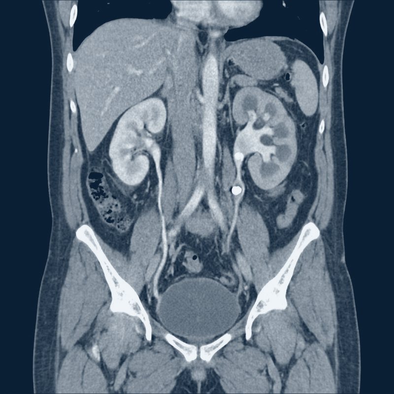 Illustrative coronal CT of the kidneys and ureters showing an obstructing left ureteral stone