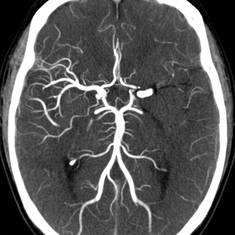 Illustrative CT angiogram of the head showing a left M1 middle cerebral artery occlusion